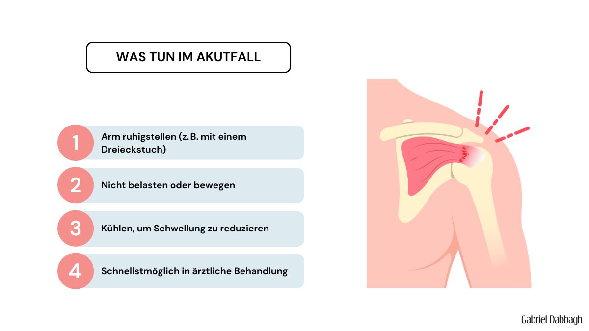 Infografik mit vier Erste-Hilfe-Maßnahmen bei Schulterverrenkung: Arm ruhigstellen, nicht bewegen, kühlen, schnell ärztlich behandeln – daneben schematische Abbildung einer verletzten Schulter.