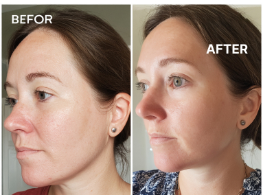 Ozempic Took the Fat-Can Red Light Bring Back the Bounce?