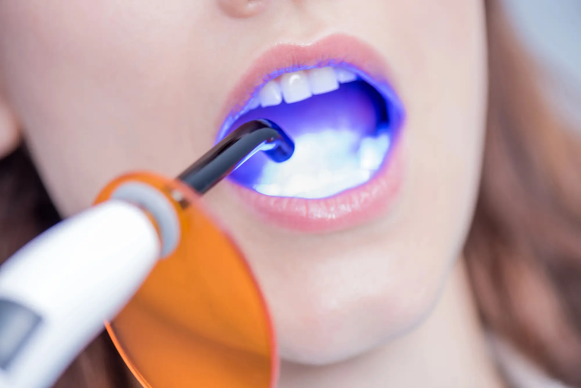 In-Office Professional Teeth Whitening vs. Over-the-Counter Strips 