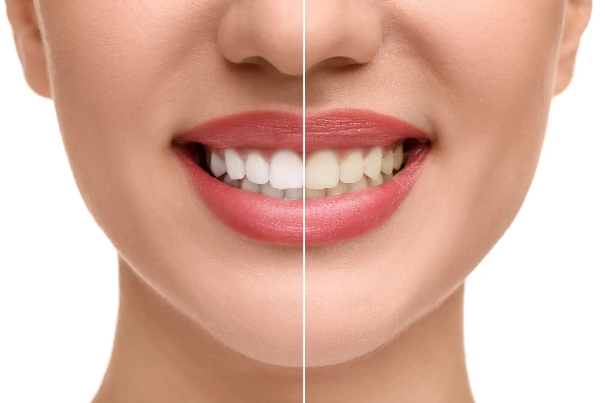 5 Factors That Can Affect How Well Teeth Whitening Works 