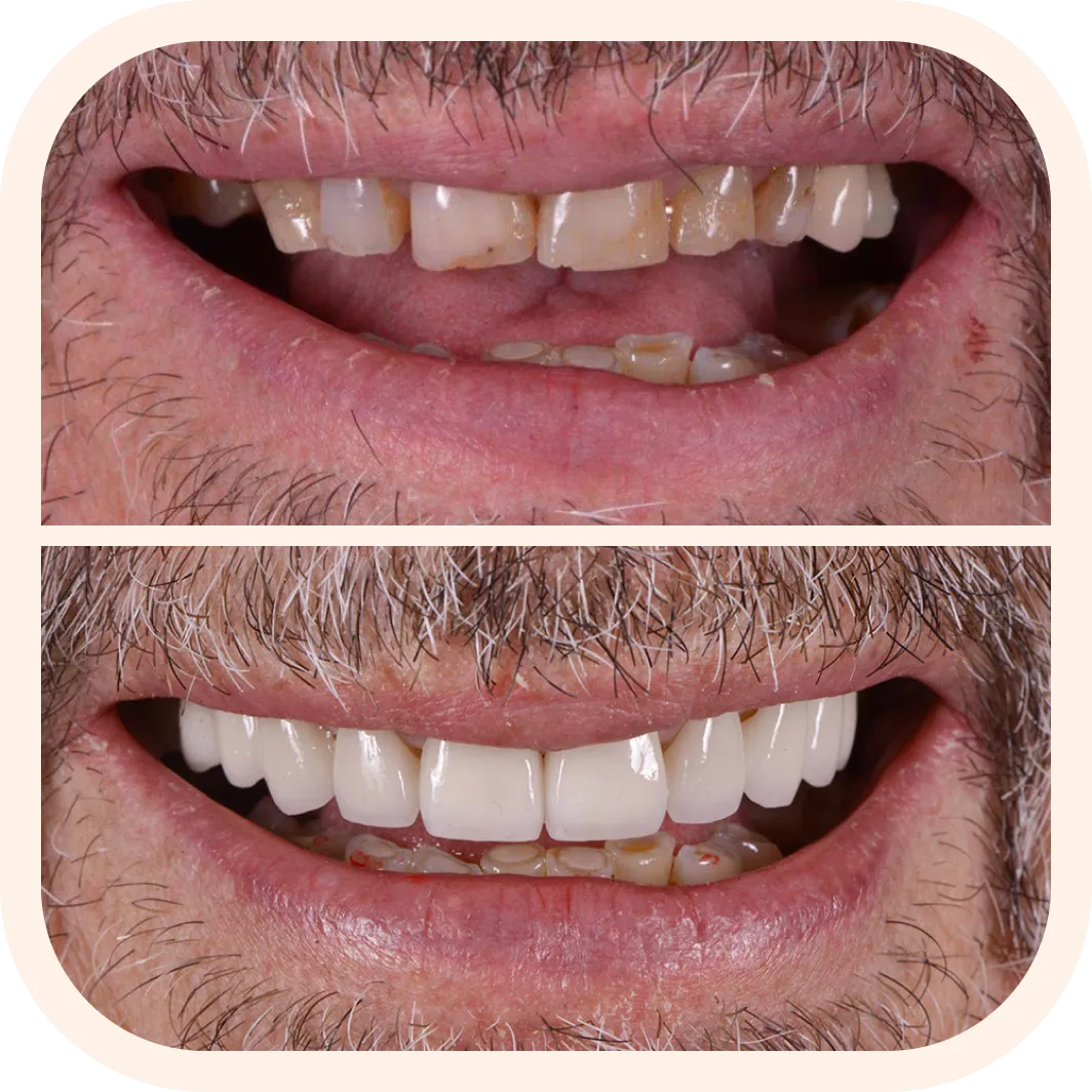 Smile Transformation consultation at Arc Dental — Before and After photo