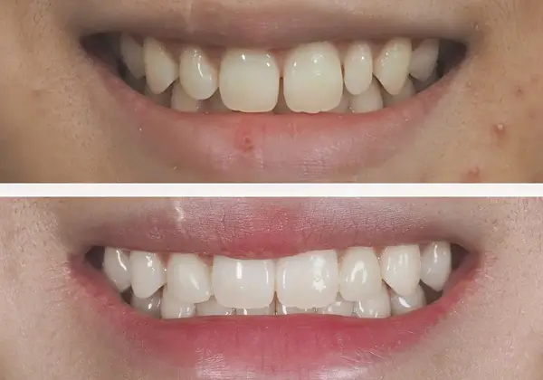 Dental veneers before and after