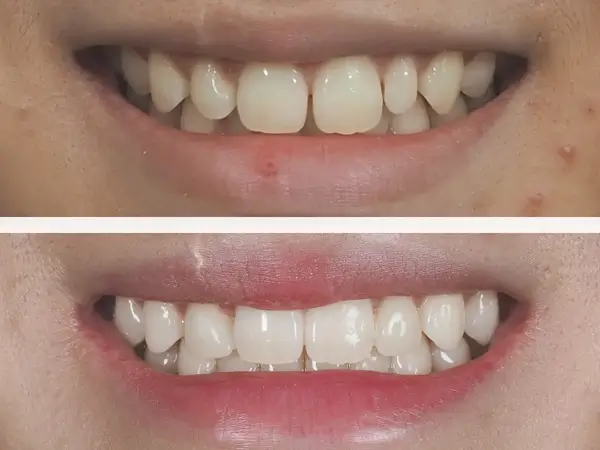 Smile makeover before and after 4