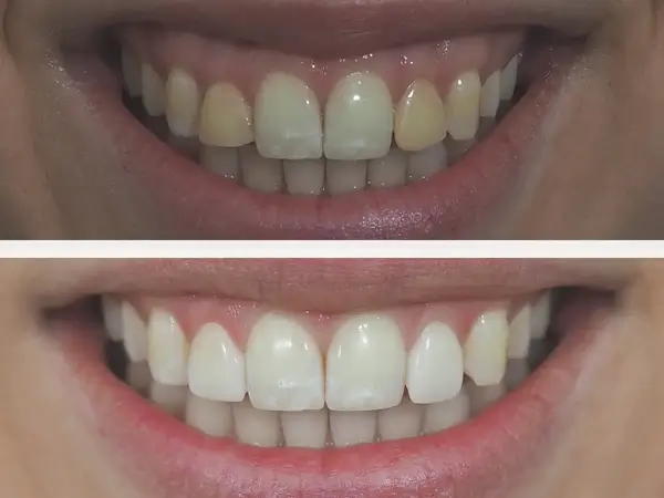 Smile makeover before and after 3