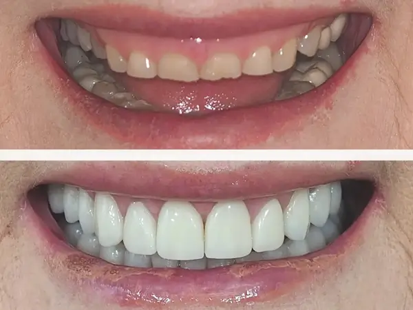 Smile makeover before and after 1