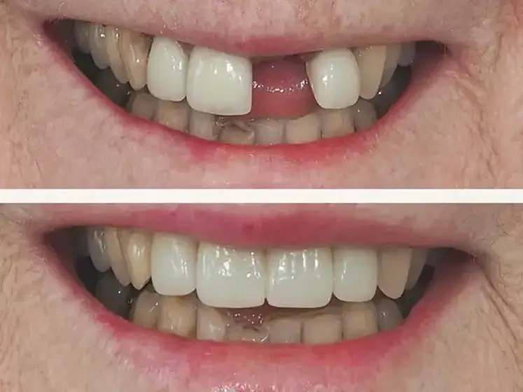 Before After Case 4