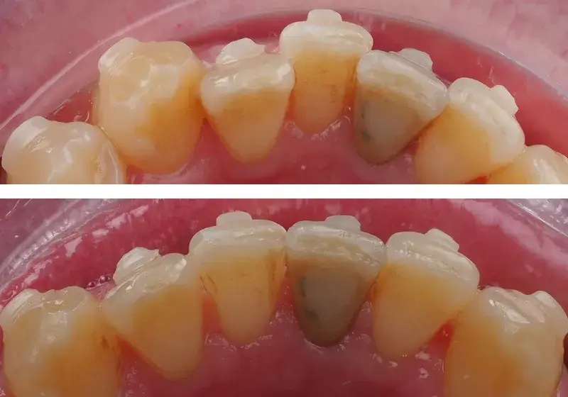 Before After Case 5