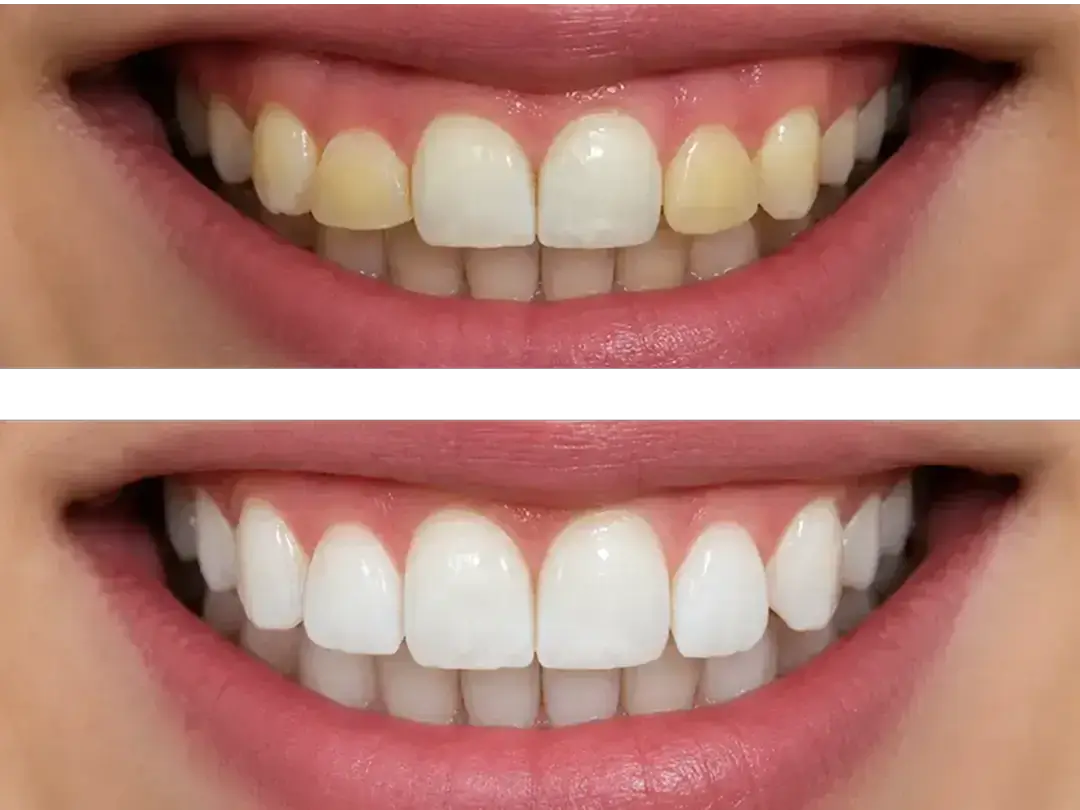 Before and after smile showing cosmetic dental veneers