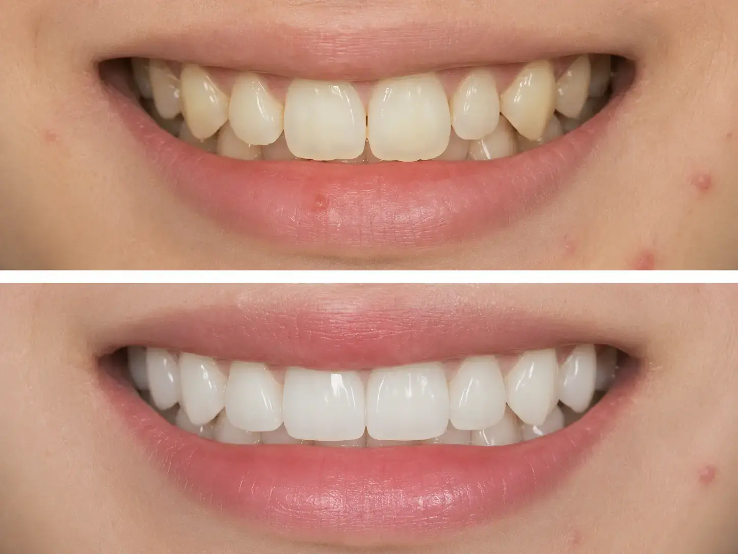 Before and after smile showing improved tooth shape and colour