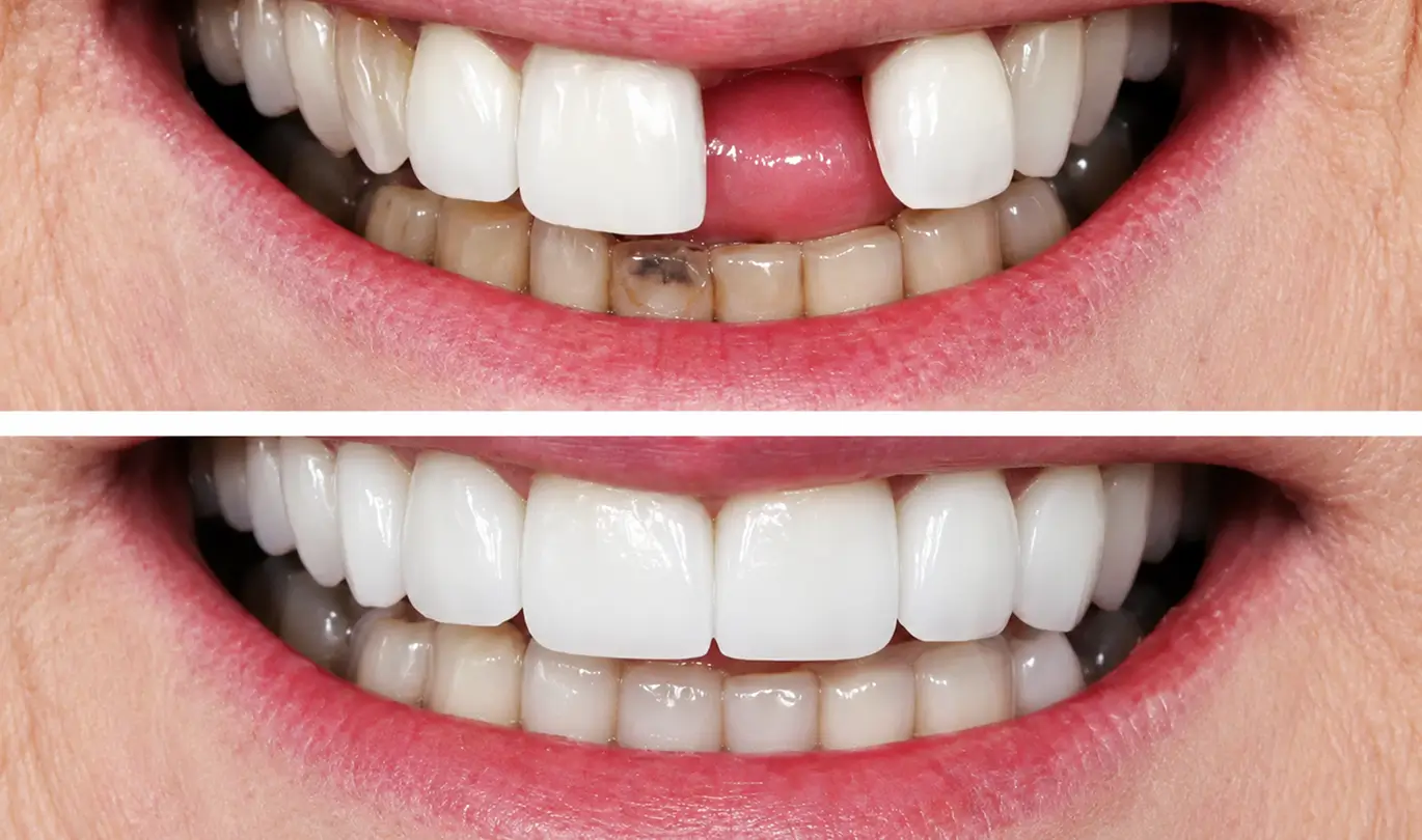 Before and after front tooth restoration