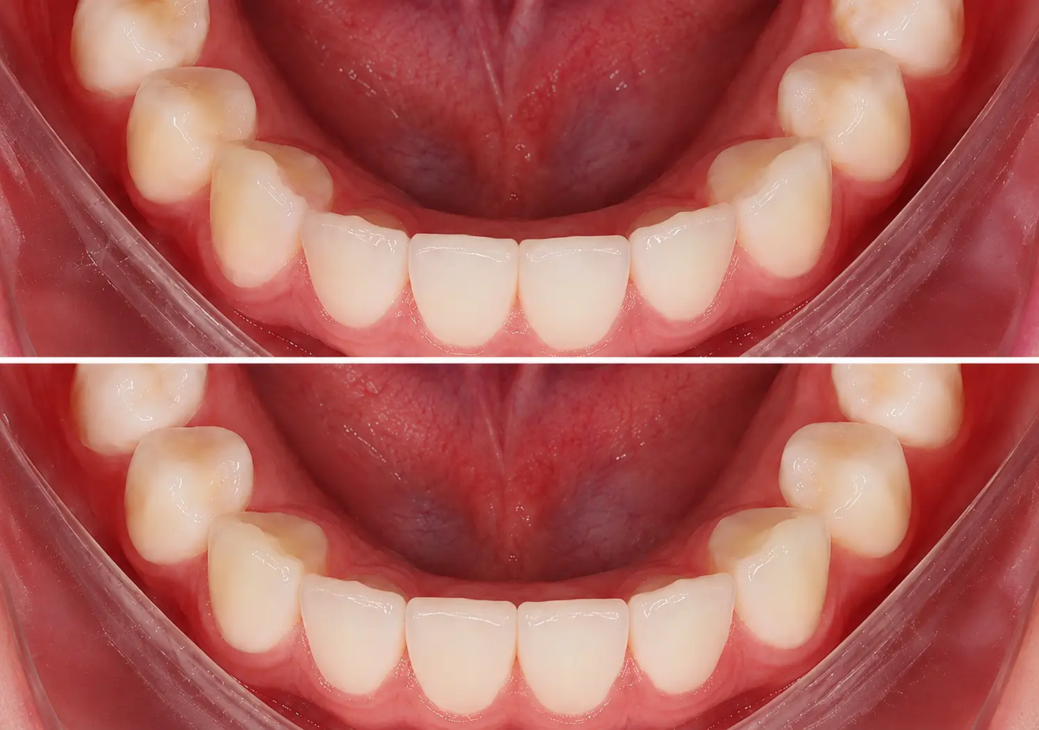Before and after lower teeth alignment