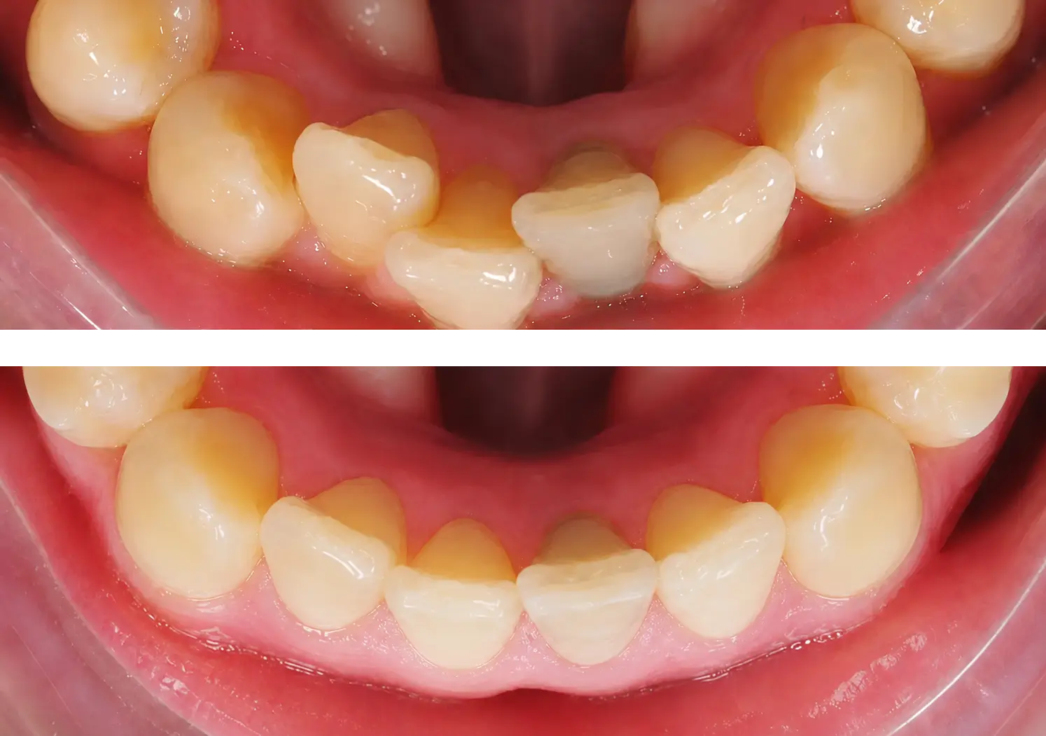 Before and after lower front teeth alignment