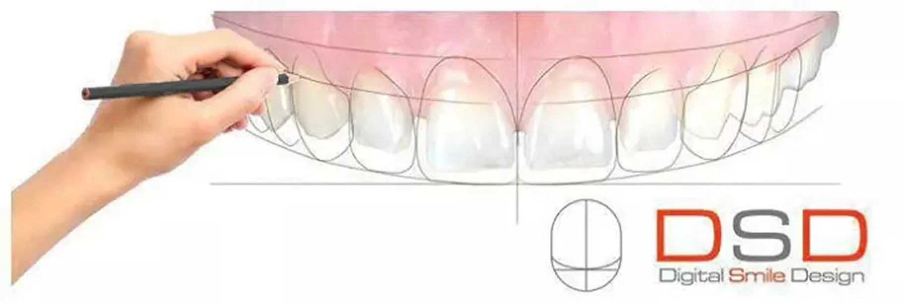 Image of the digital smile design software where dentists can carefully plan how veneers will be produced to match the patient’s natural teeth and facial features.