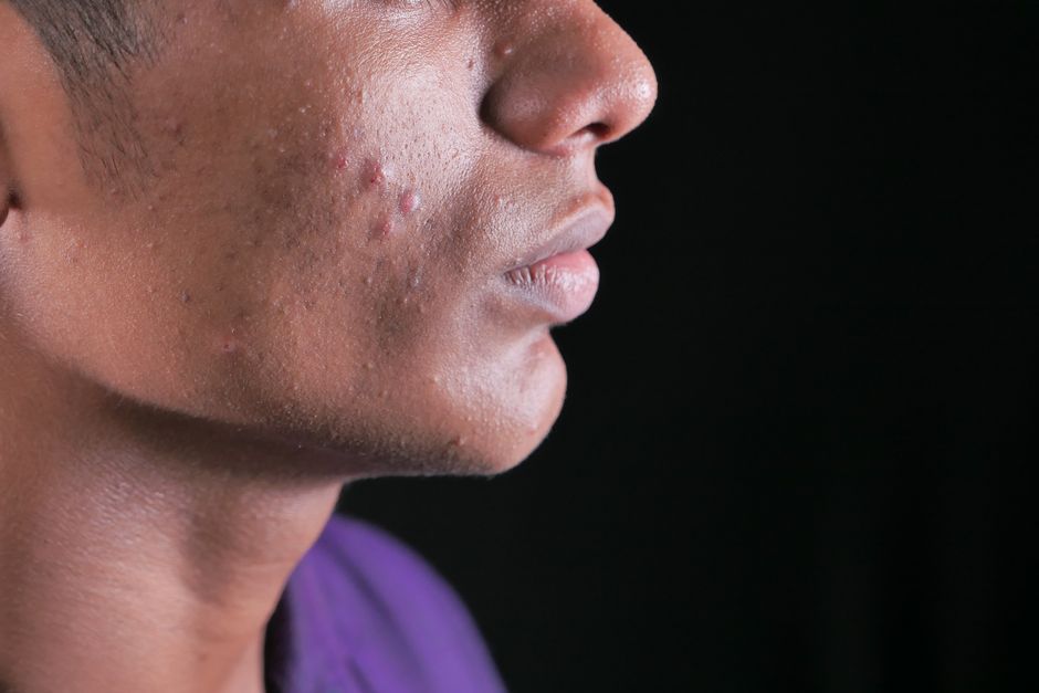 Does Adderall Cause Acne? The Real Connection