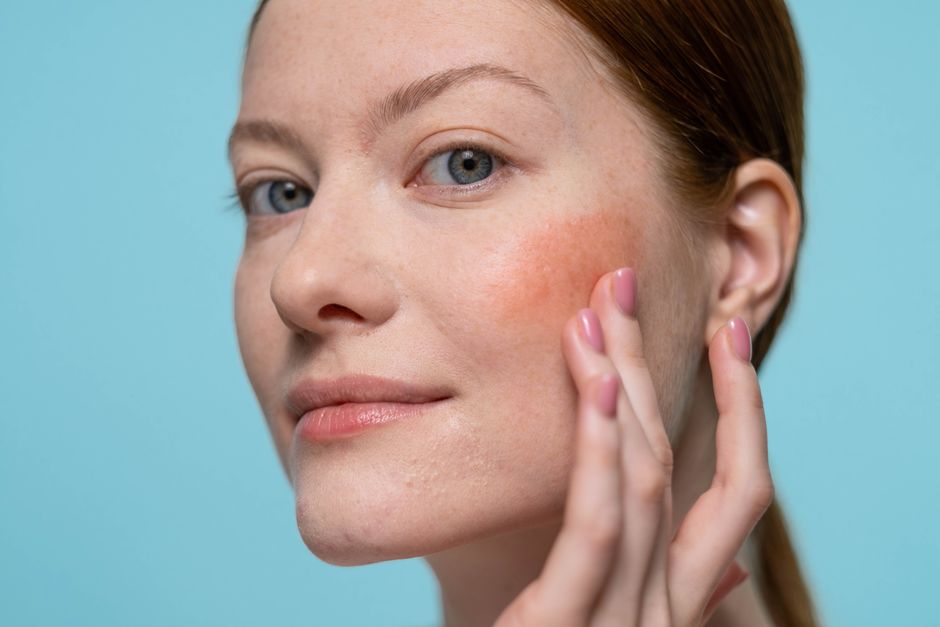 type 2 rosacea