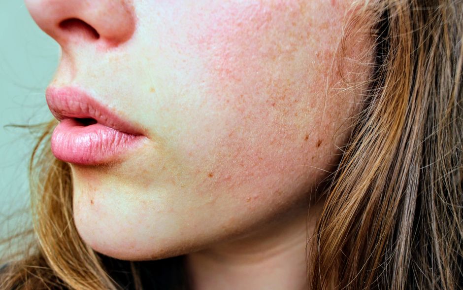 type 2 rosacea
