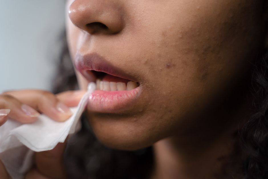 does soda affect acne
