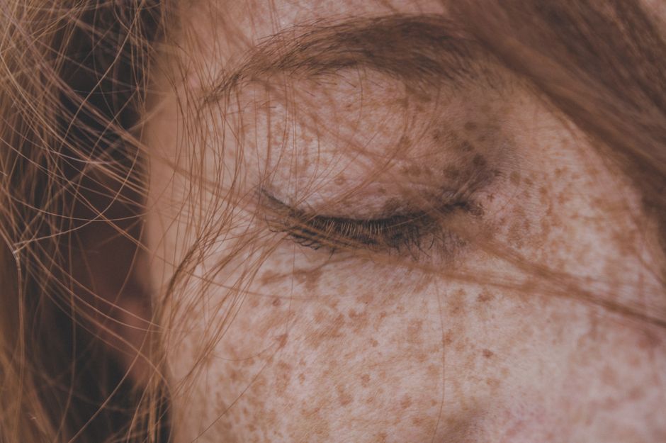 Melasma vs Hyperpigmentation: What's The Difference?