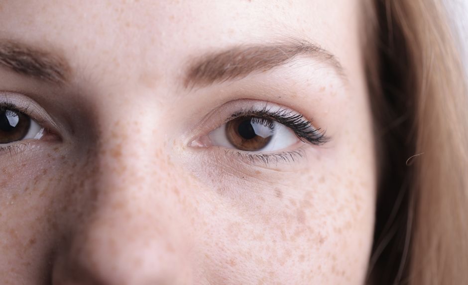 melasma vs hyperpigmentation