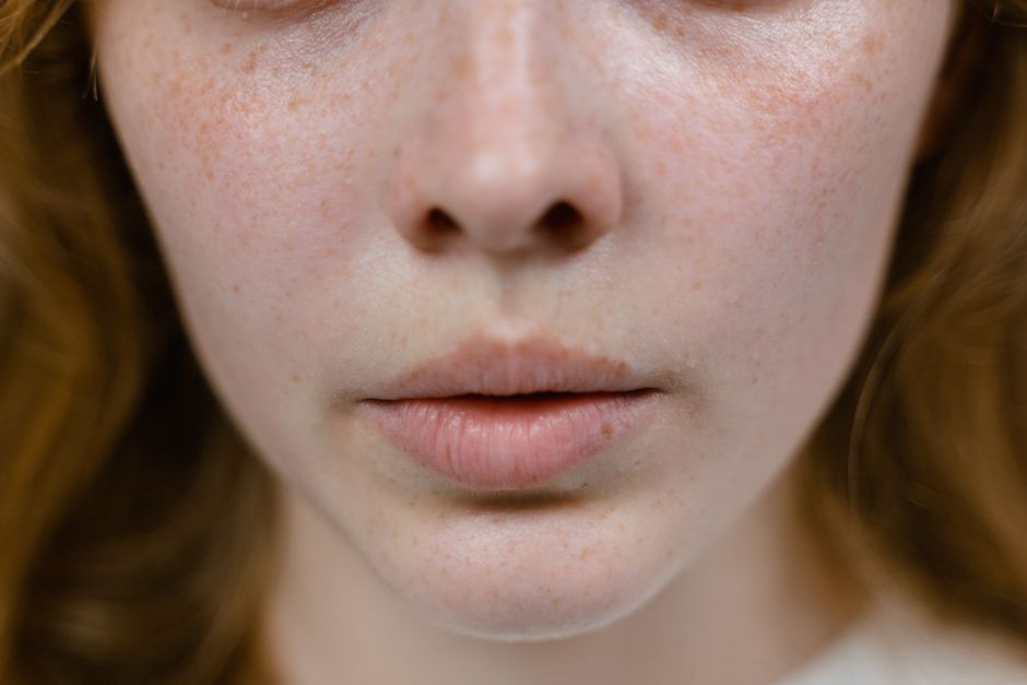 melasma vs hyperpigmentation