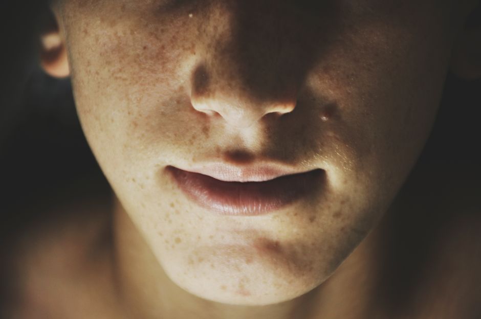 hyperpigmentation around mouth