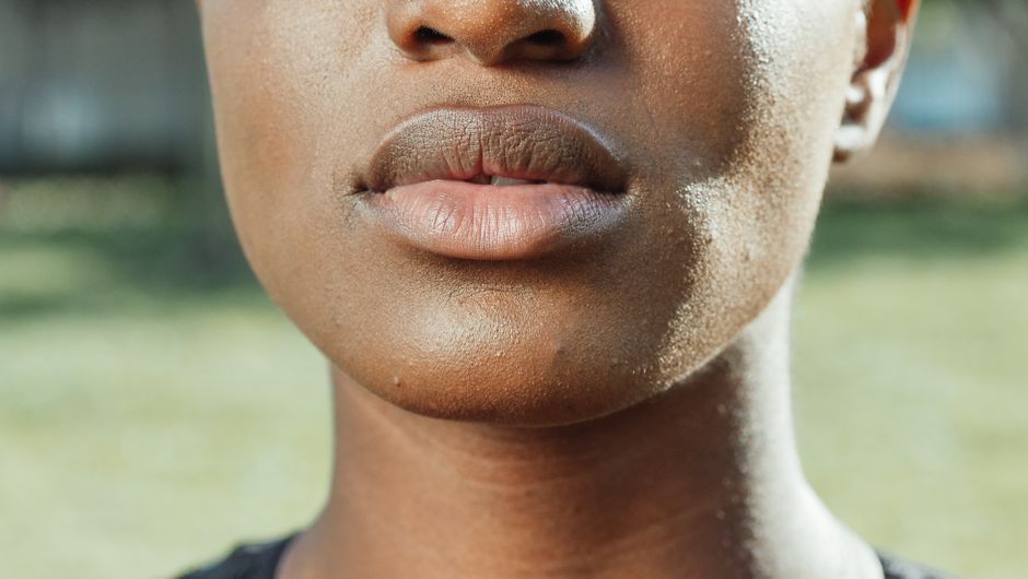 hyperpigmentation around mouth