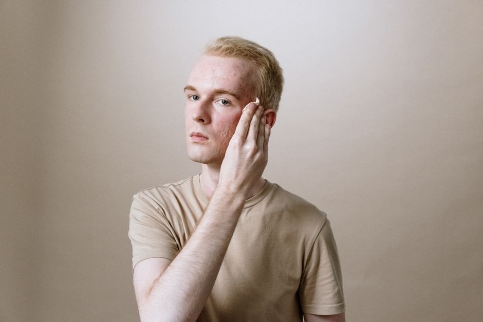 does ice help acne