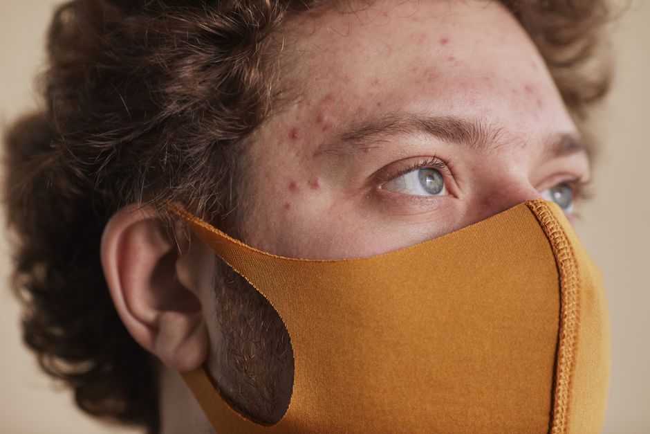 does ice help acne