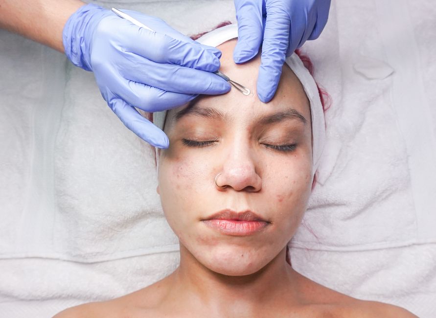 Facials for Acne: Do They Work & How Often?