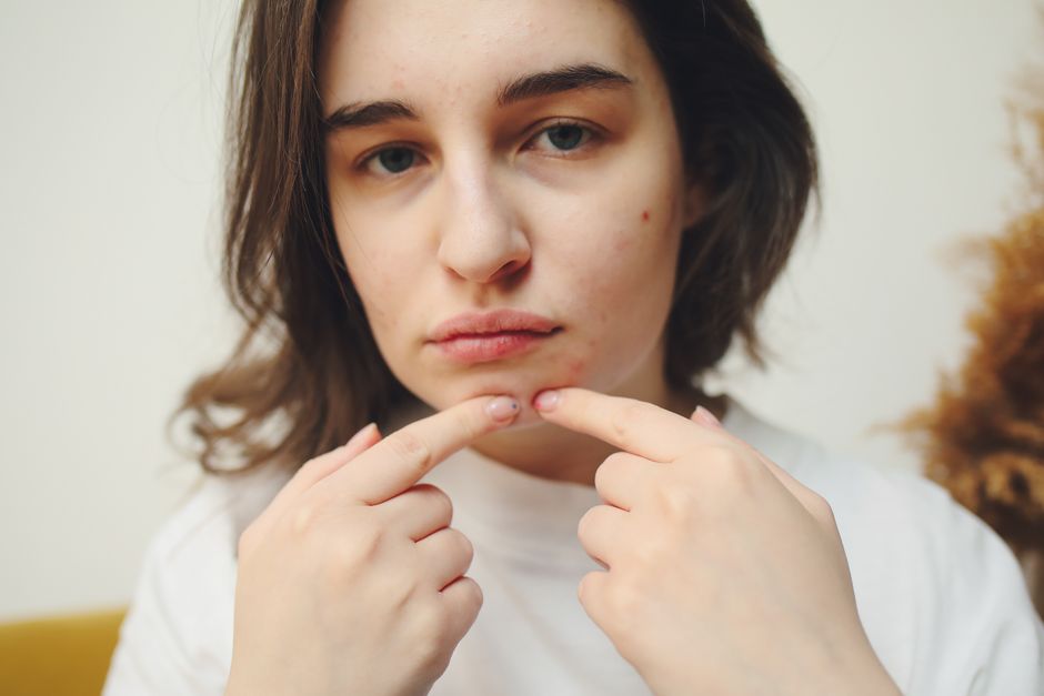 does exercise help acne