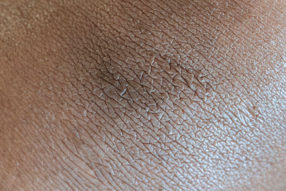 Can Dry Skin Cause Spots? The Real Connection