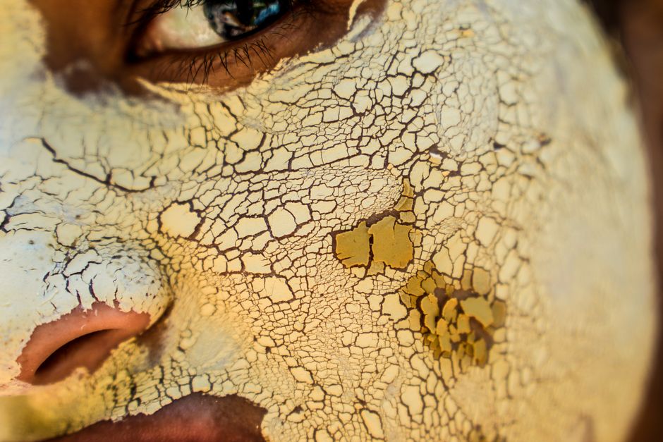 can dry skin cause spots