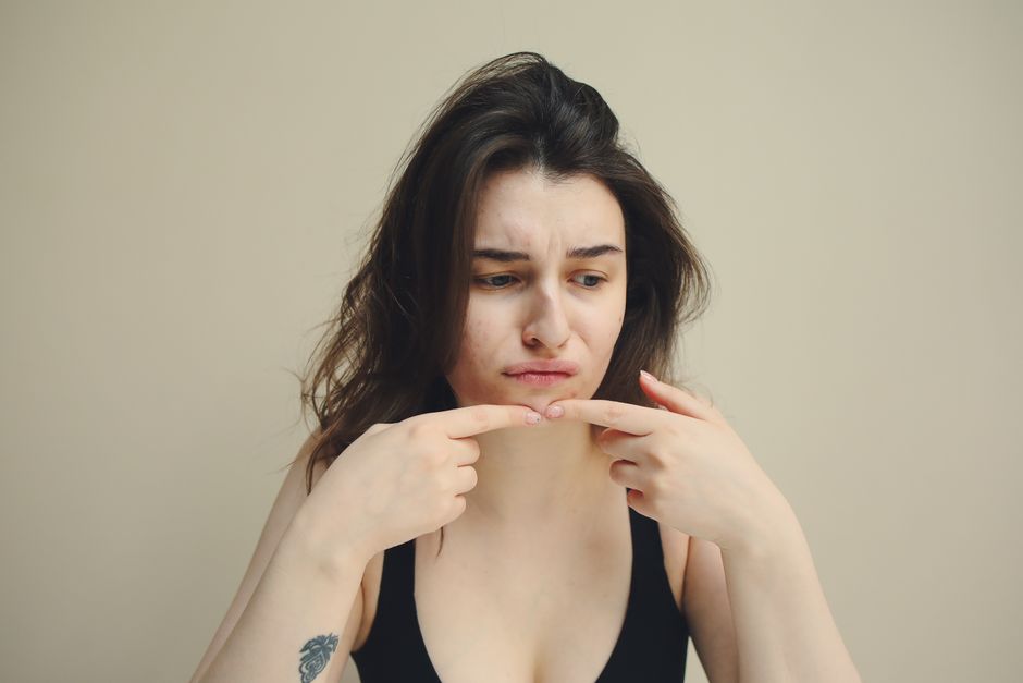 acnes blemish