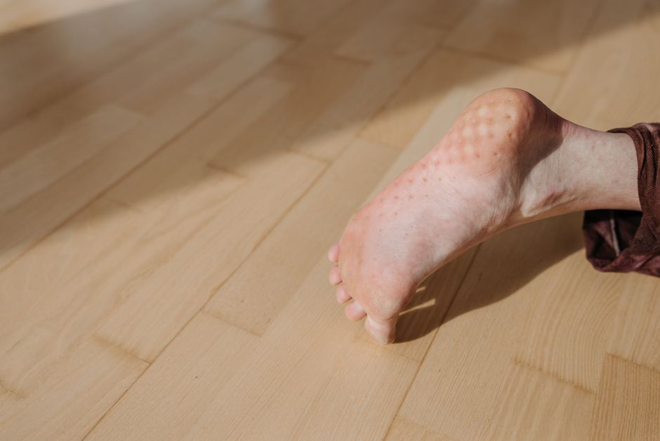 dry foot skin