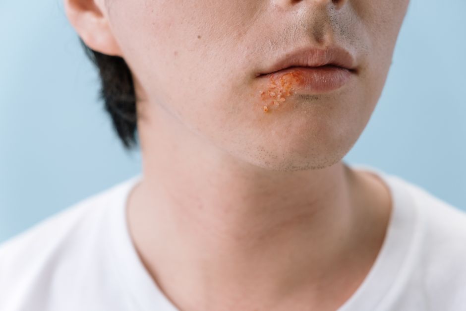 Is Rosacea an Autoimmune Disease? What You Need to Know