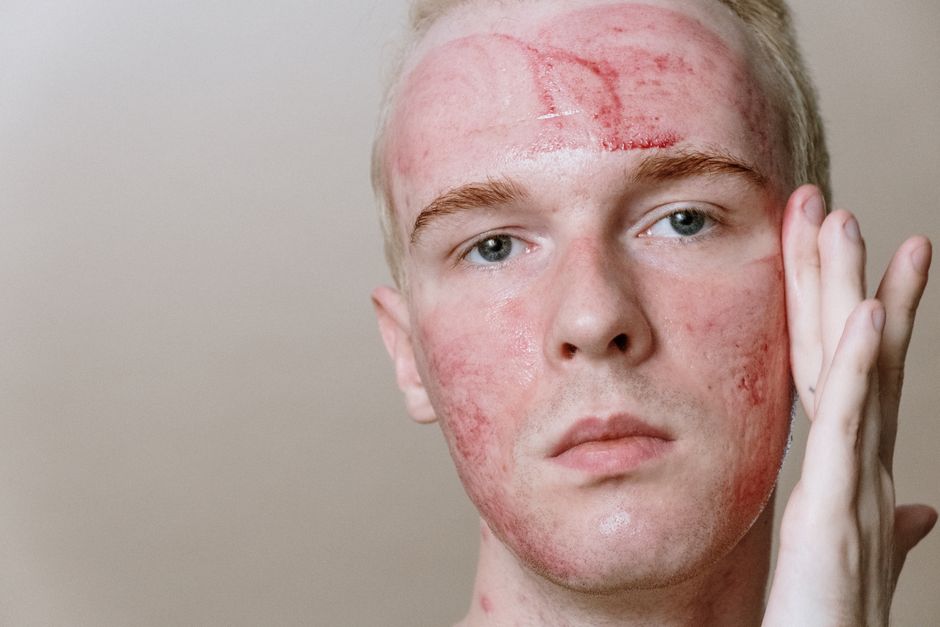 lymphatic acne