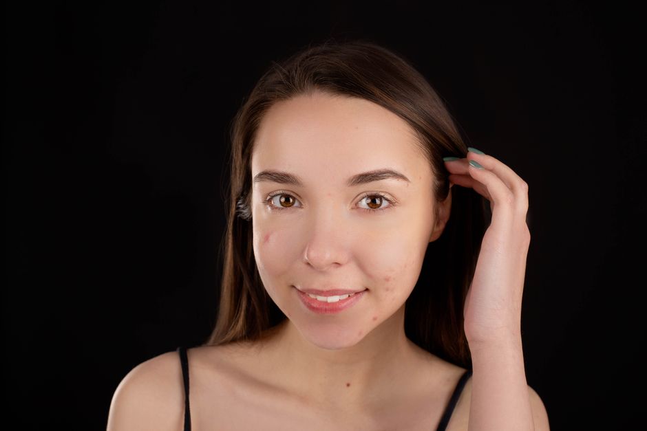 How Long Does It Take for Acne Scars to Fade? Timeline & Tips