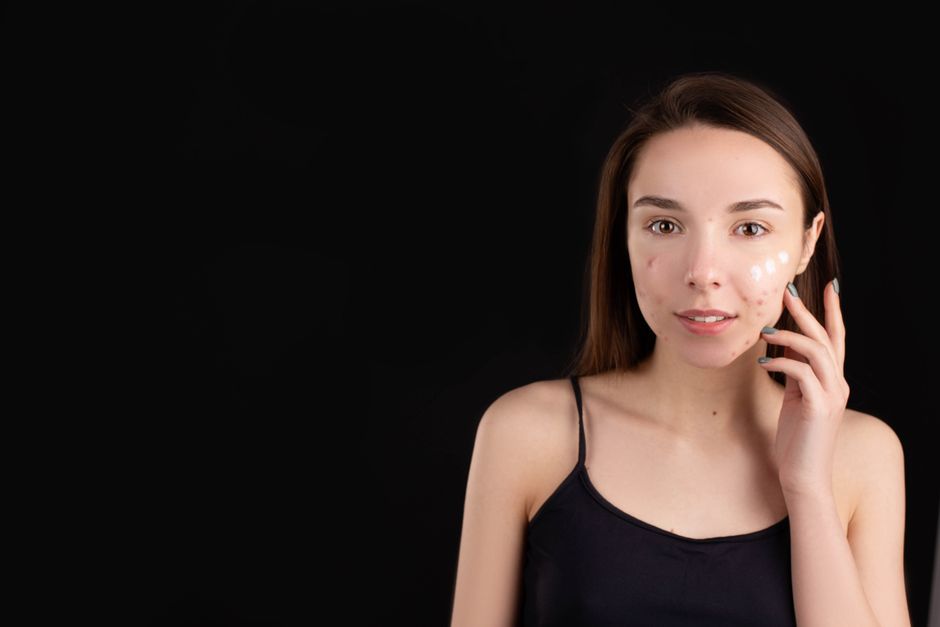 does tanning help acne