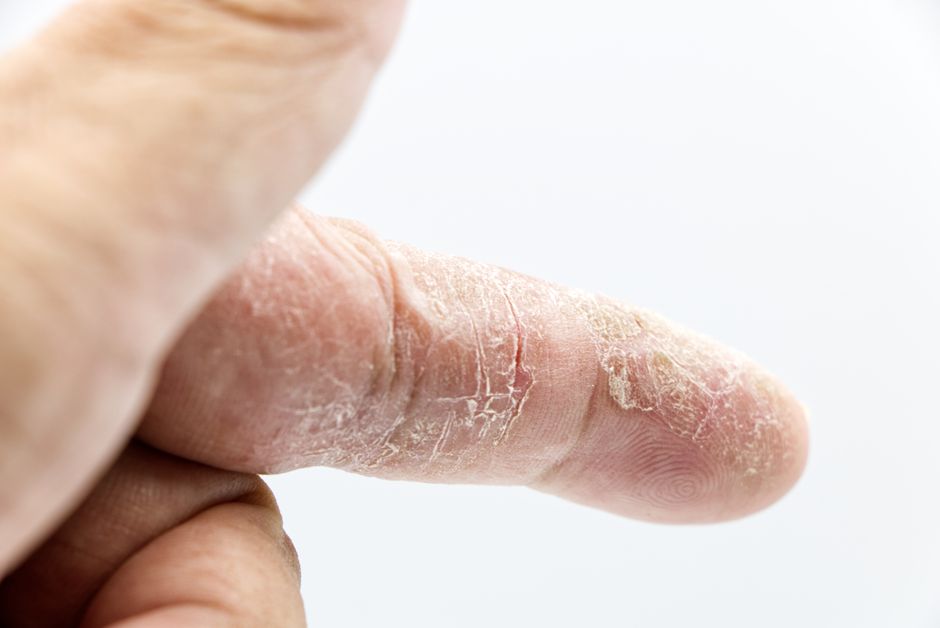 eczema vs dry skin