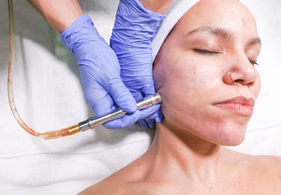 does exfoliating help with acne