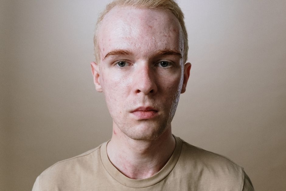 fungal acne vs bacterial acne