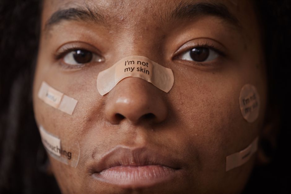 Why Is My Acne Itchy? 2026 Guide: Causes & Best Skincare Solutions