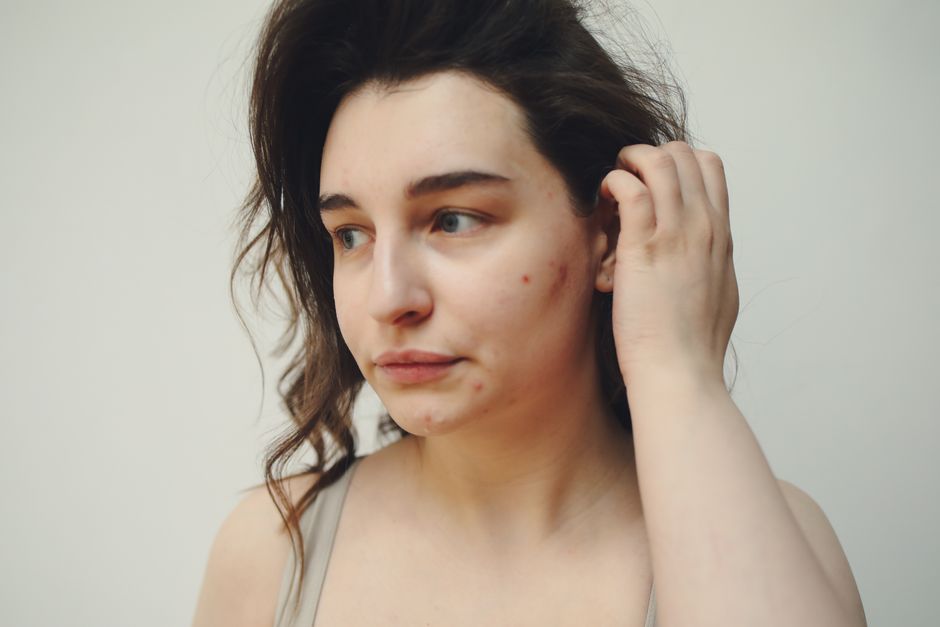what is the best makeup for acne-prone skin