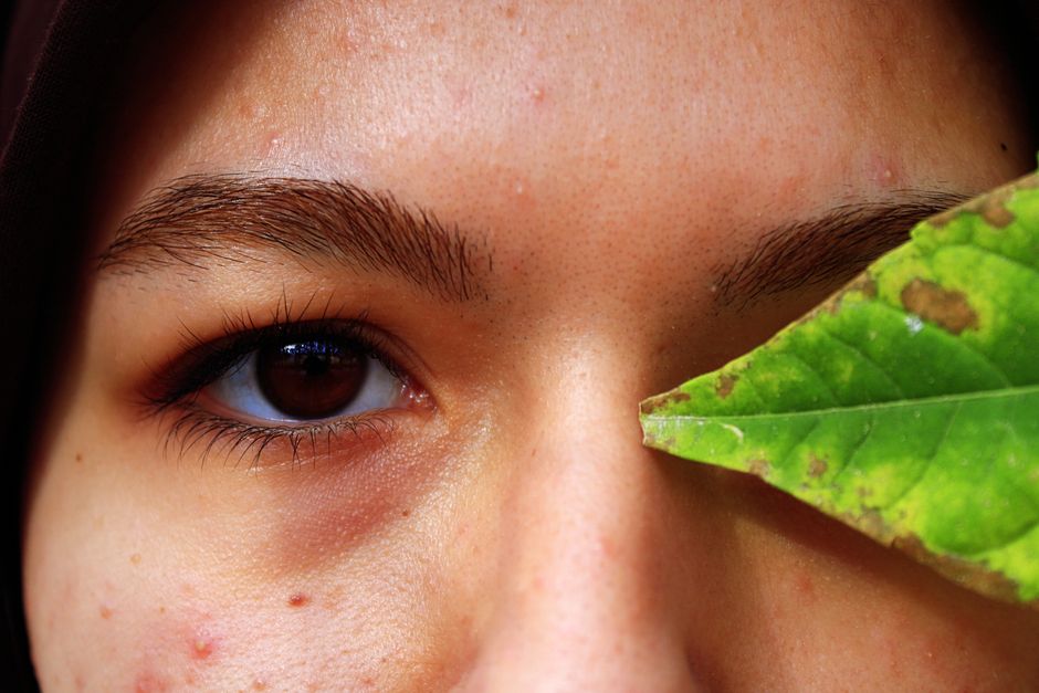 Lymphatic Acne: Causes, Diagnosis & Natural Treatment Guide