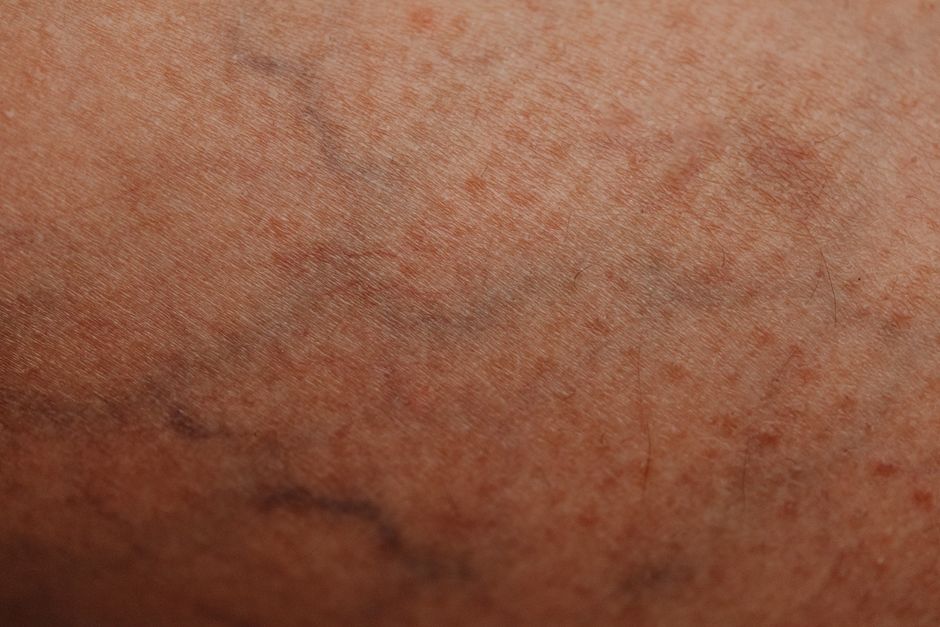 hyperpigmentation more visible when cold