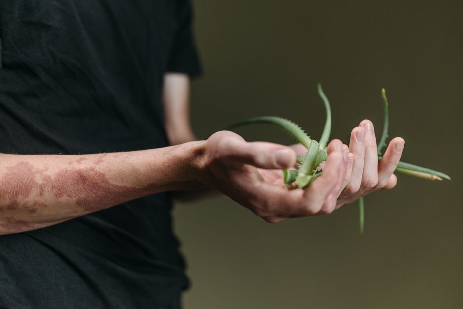 is aloe vera good for eczema