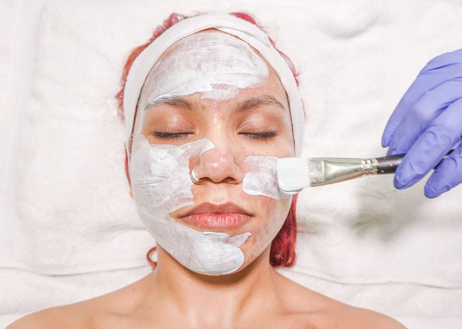 best chemical peel for hyperpigmentation