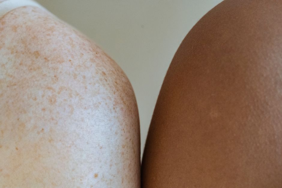images of hyperpigmentation