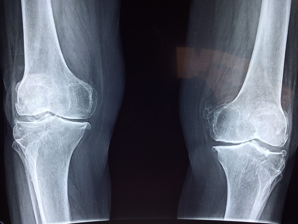 Knee Injury Compensation