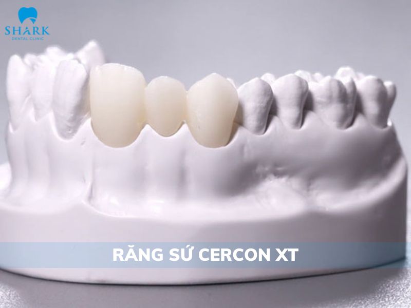 Răng sứ Cercon XT thế hệ mới có những nổi bật gì?